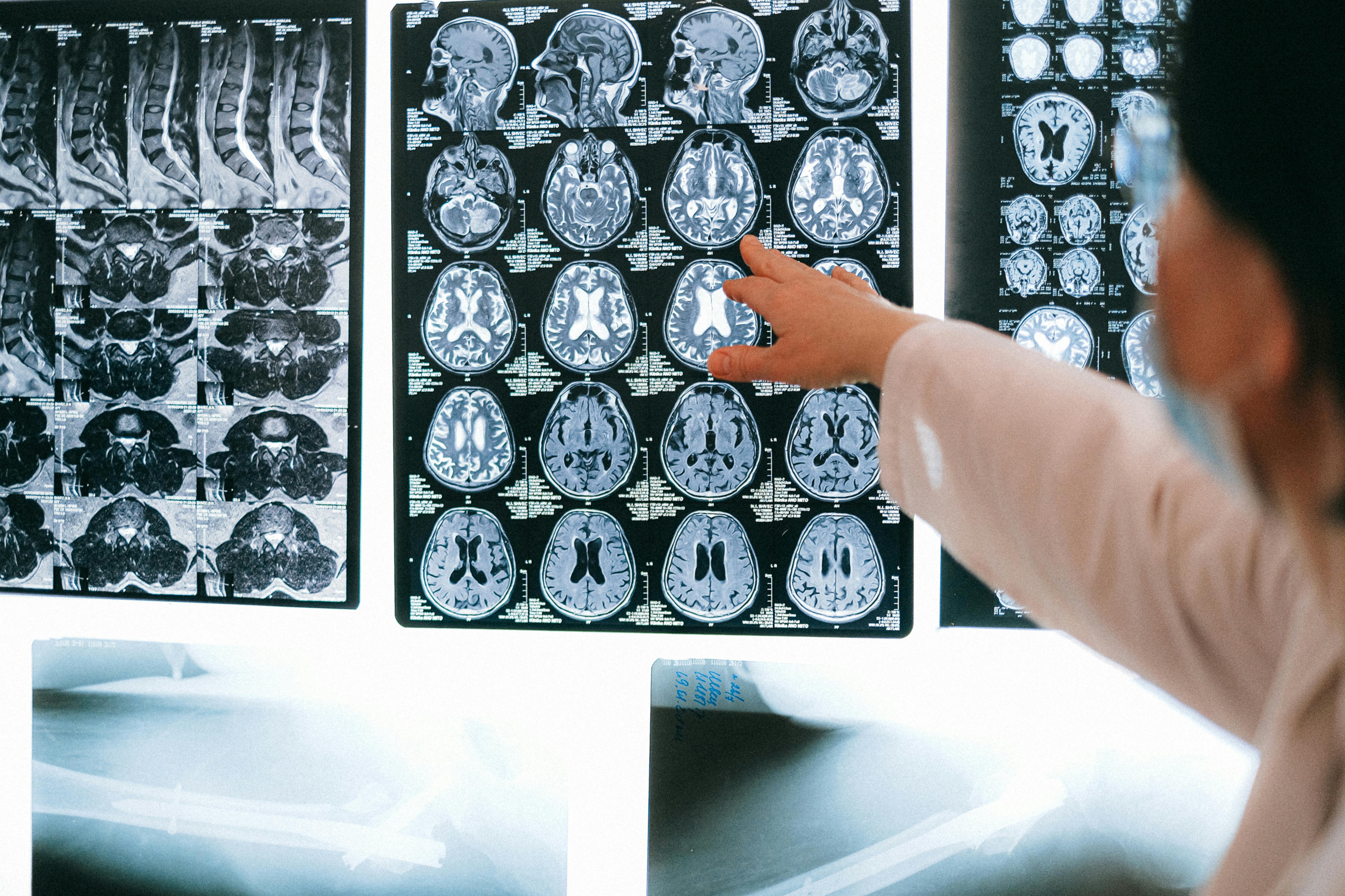 How MRI Technology Revolutionized Early Brain Tumor Detection
